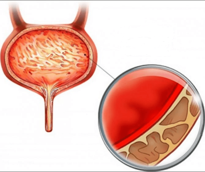 Inflammation de la cystite